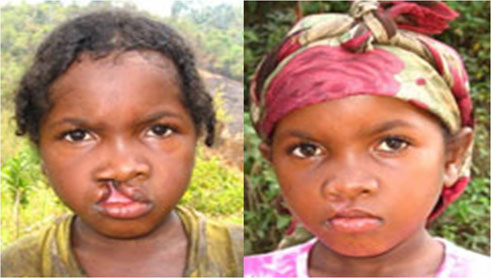 Aya ni amasura atandukanye y'uwahoze arwaye ibibari akavurwa agakira