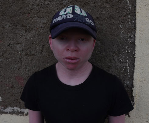 Bikorimana ahorana ingofero mu mutwe kubera uruhu rwe rutinya izuba.