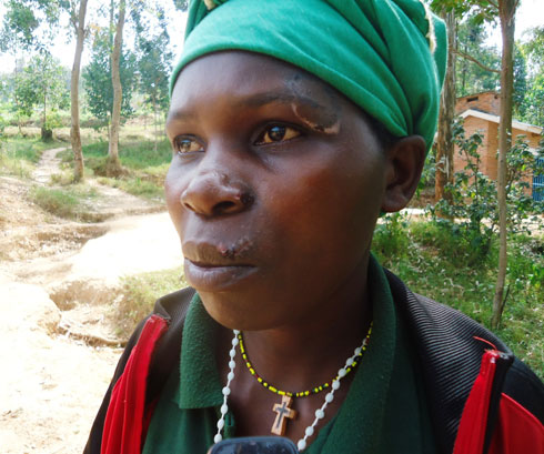 Nkurizehe afite ibikomere mu maso yatewe n'umugabo we. (Foto:L.Nshimiyimana)