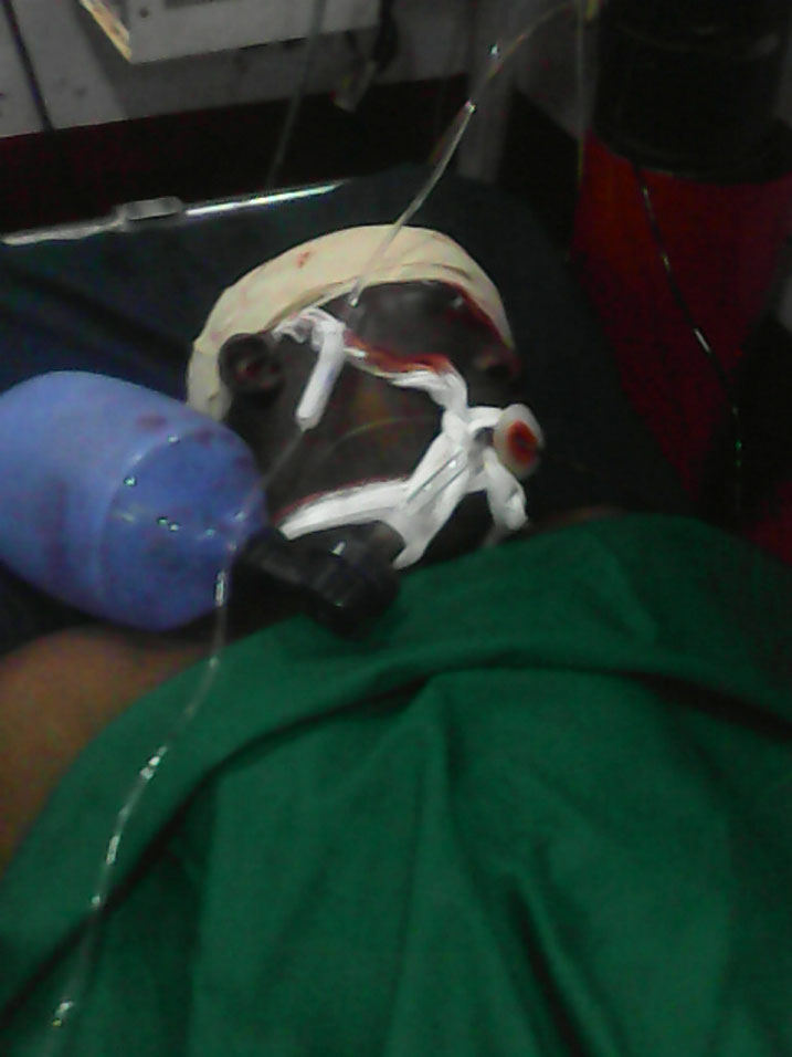 Umwe mu bakomeretse bikomeye yahise yoherezwa mu bitaro bya CHUK afashwa guhumeka.