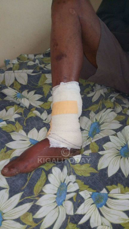 Bamubaze akaguru nyuma yo gukomereka ku kirenge, akaguru kakabyimba