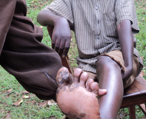 Ngo hari umuti ashyiraho bigakira ariko nyuma y