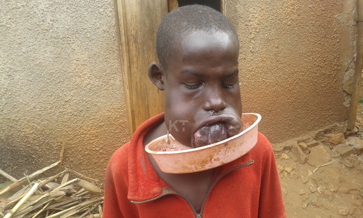 Bamukoreye akabase kamurinda umwanda uturuka muri ubwo burwayi.