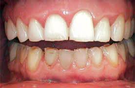 Amenyo yarangiritse kubera kuyahekenya