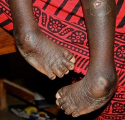 Hari abana bavukana ubumuga bwo guhengama ibirenge. Iyo ngo bavuwe hakiri kare bashobora gukira 