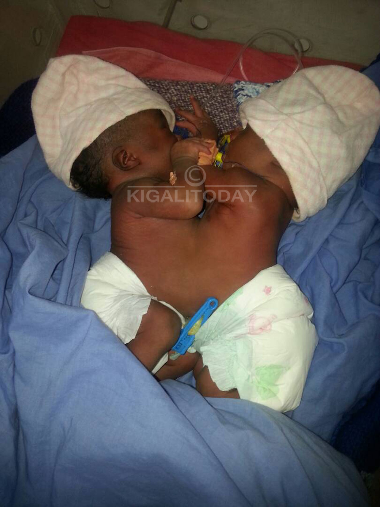 Abana bavutse bafatanye Inda ariko ngo bameze neza