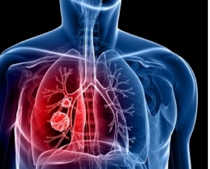 Abarwara igituntu mu Rwanda baragabanutse