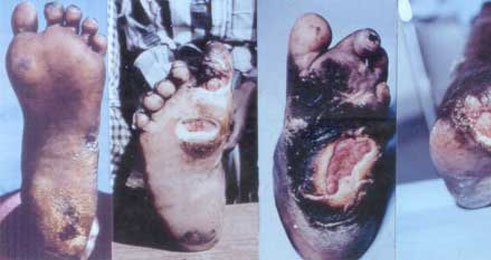 Zimwe mu ndwara zikunze kwibasira abatuye mu cyaro kubera umwanda.