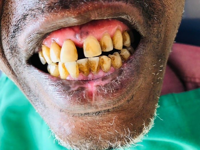 Isuku nke yo mu kanwa itera uburwayi