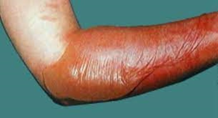 Amazi afasha gupfubya ubushye ntibugere mu nyama cyane ndetse no ku igufa