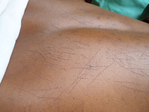 Uko ibirozi byasharambuye Kankindi mu mugongo