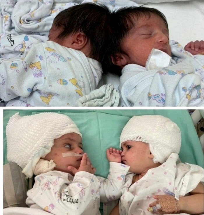 Uko abo bana bari bameze mbere, na nyuma yo kubagwa 