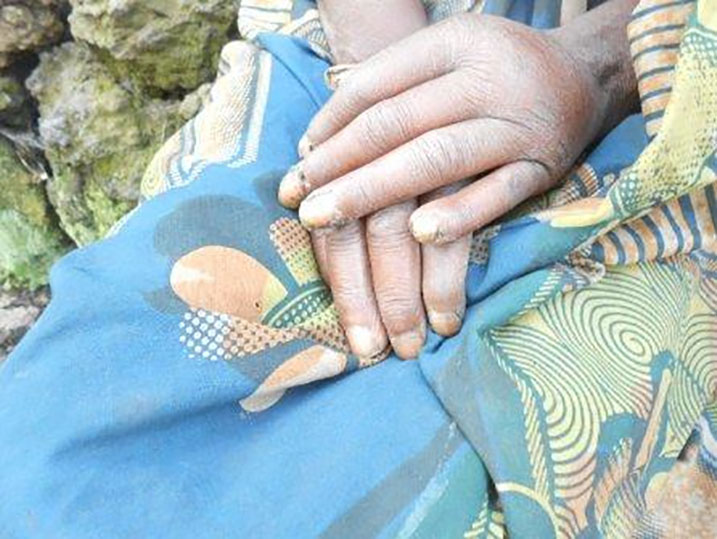 Bamwe mu barwaye amavunja bo mu Mujyi wa Rubavu bavuga ko ari ay