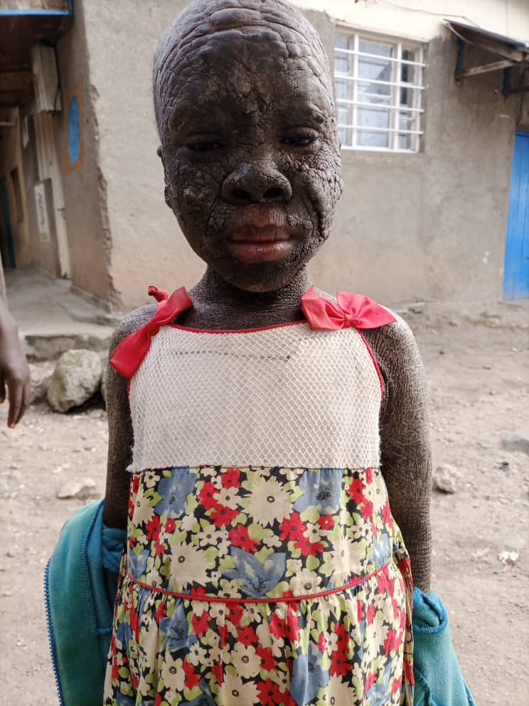 Iyi ndwara idasanzwe yari ayimaranye imyaka 12 ikaba itangiye kugenda yoroha