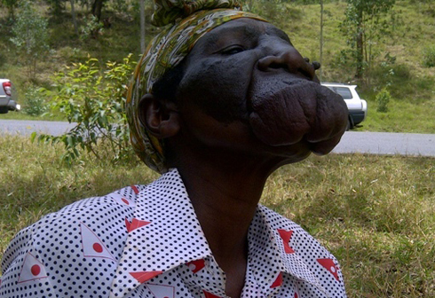 Uzanyinzoga Suzan ubu burwayi yabuvukanye ari buto, ariko bugenda bwiyongera.