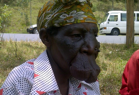 Uburwayi bwe ubu bwatangiye gusatira ibice byo mu maso.