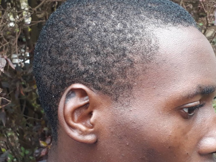 Inkovu Twambazimana afite ku gutwi yayitewe n'urushyi yakubitiwe muri gereza