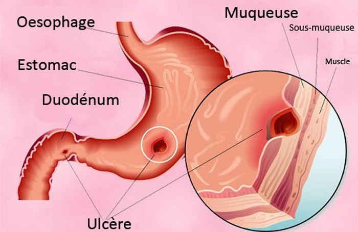 Ulcere duodenal