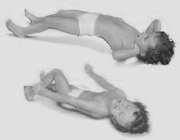 Umwana urwaye tetanos