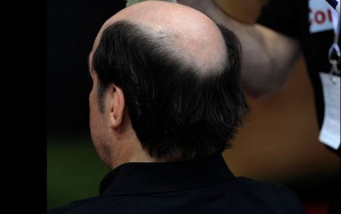 Kumera uruhara rwo hejuru ngo bishobora kuba ikimenyetso cy