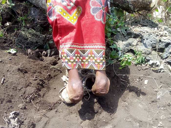 Uwimana afite ubumuga butuma atabasha kugira icyo yikorera