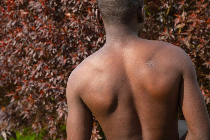 Ruzigamanzi afite inkovu mu mugongo no ku maguru zigaragaza iyicarubozo yakorewe