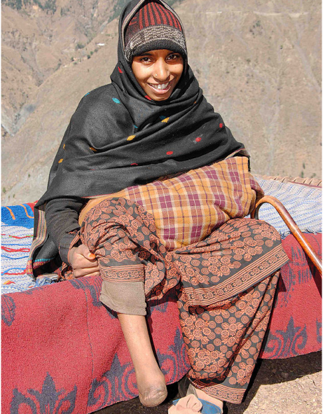 Mama w'umwana yavutse afite ukuguru kumwe kutuzuye.