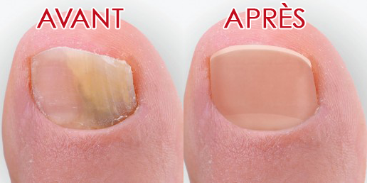 Iyi ndwara iravurwa igakira. Ino riragaragaza uko ryari rirwaye n'uko ryahindutse nyuma yo kuvurwa