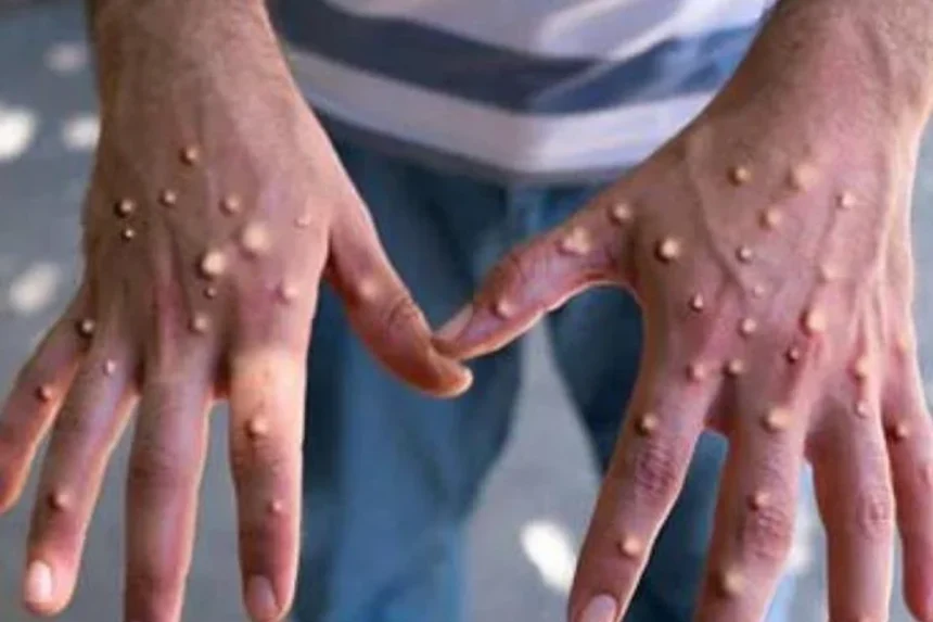 Mu Burayi havuguruwe ingamba zo guhashya no gukumira icyorezo cya Mpox