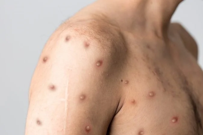 Muri Amerika habonetse umuntu wa mbere wanduye ubushita bw